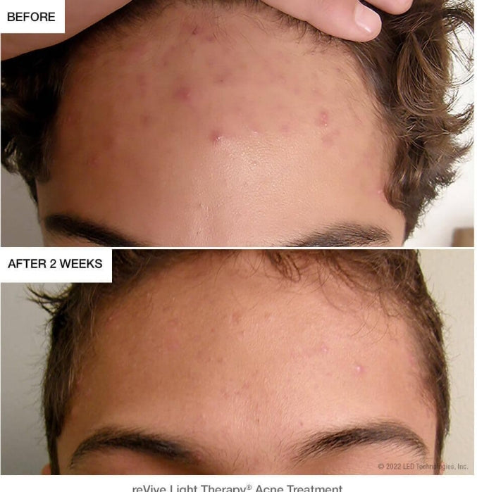 Masque Facial LED Professionnel — Anti-Âge & Éclat Garanti